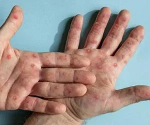 کراچی: جناح اسپتال میں منکی پاکس کا مشتبہ مریض آئسولیشن وارڈ منتقل